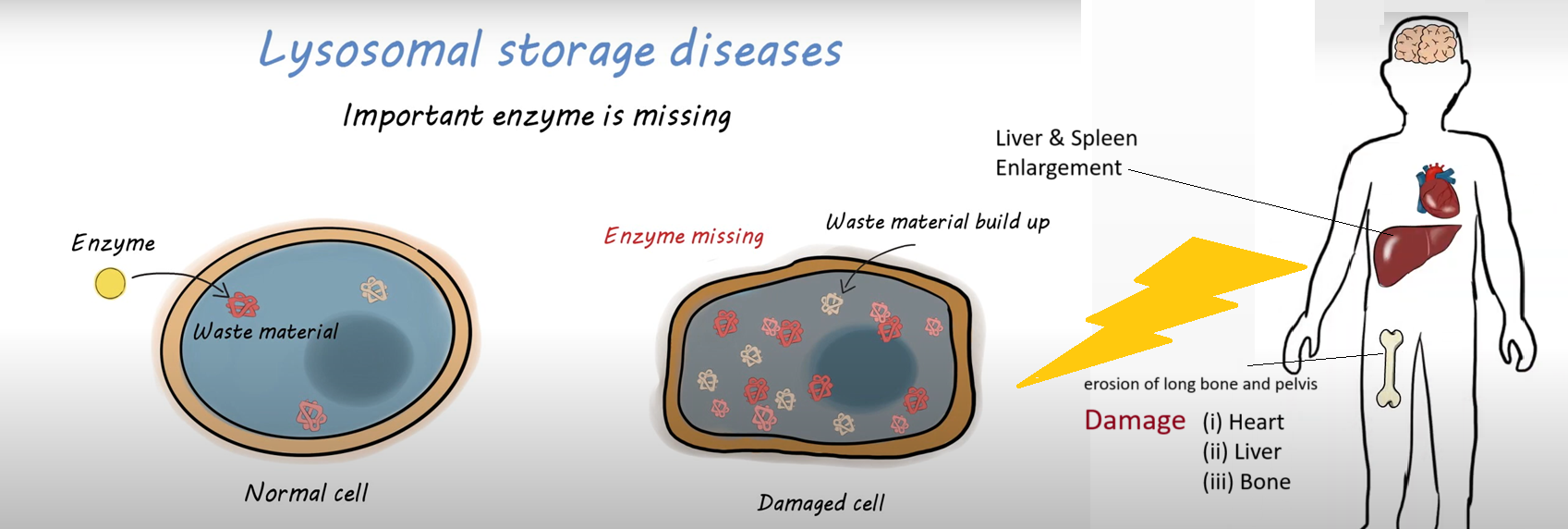 Lysosomal Storage Disorders Treatment in India